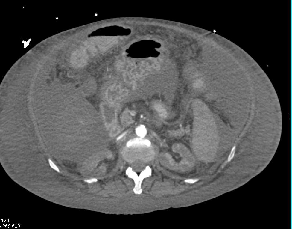 Hypotensive Patient with Ascites , Poor Renal Function and Small Caliber Superior Mesenteric Artery (SMA) and Celiac - CTisus CT Scan