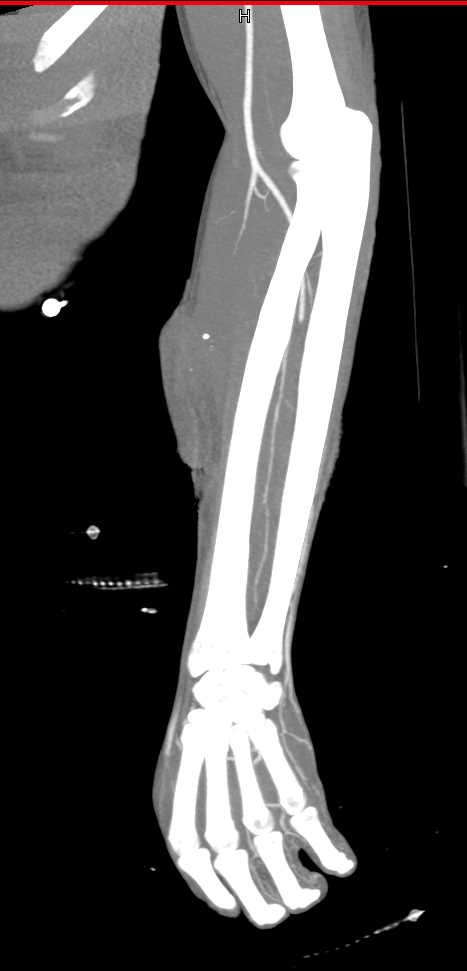 Occlusion of the Radial Artery - CTisus CT Scan