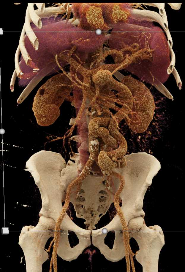 Multiple Mesenteric Aneurysms - CTisus CT Scan