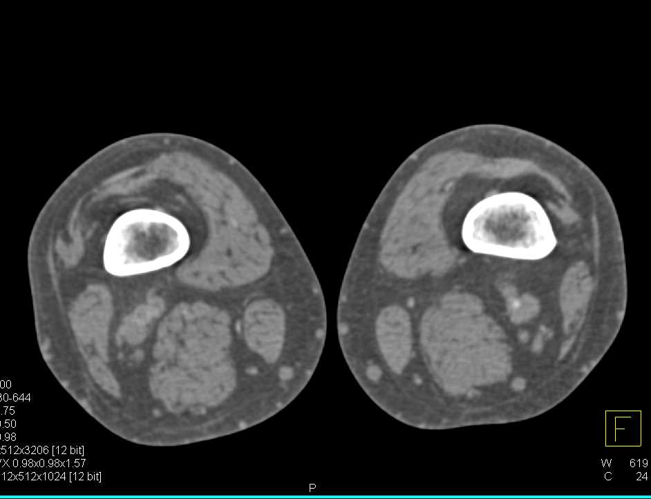 Embolization with Occlusion Flow to Lower Extremities - CTisus CT Scan