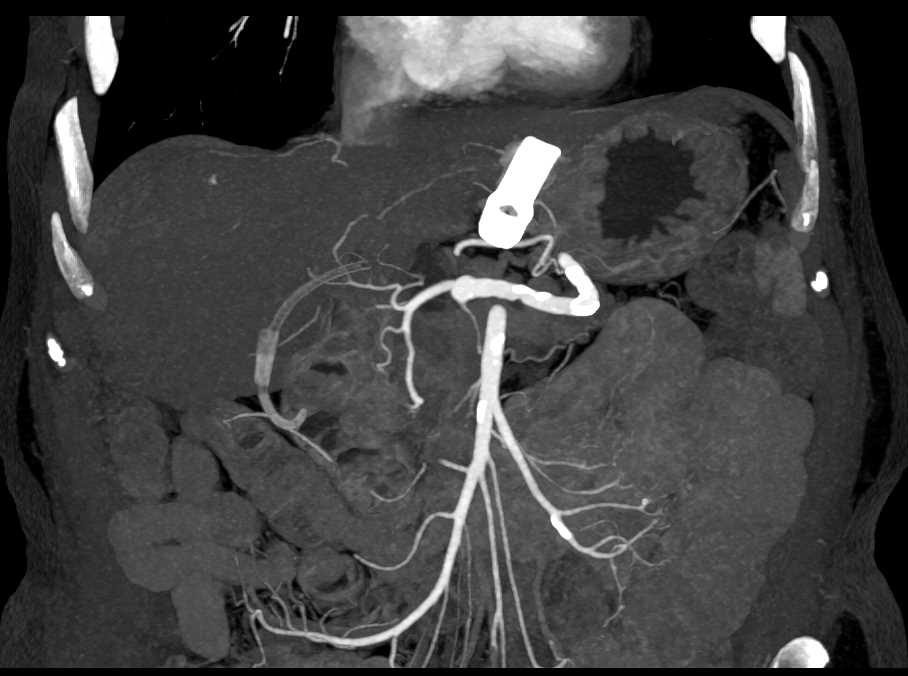 Gastroduodenal Artery (GDA) on MIP Imaging - CTisus CT Scan