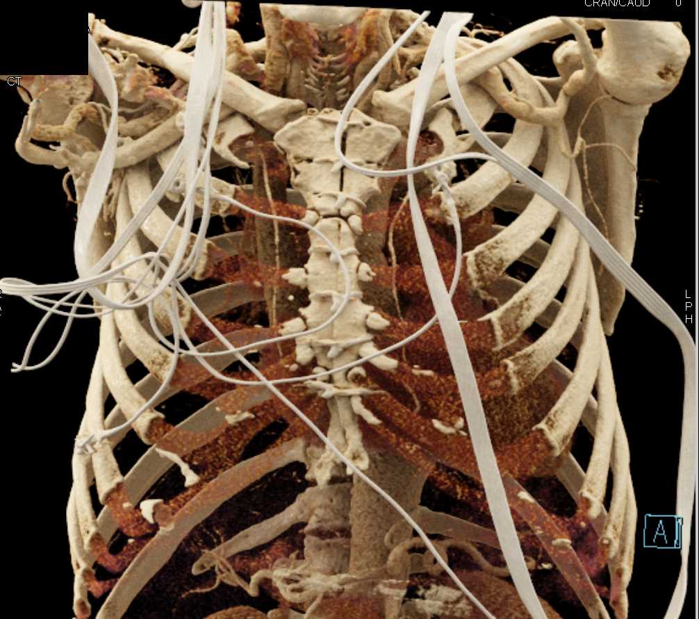 Repair of Thoracic Aortic Dissection - CTisus CT Scan