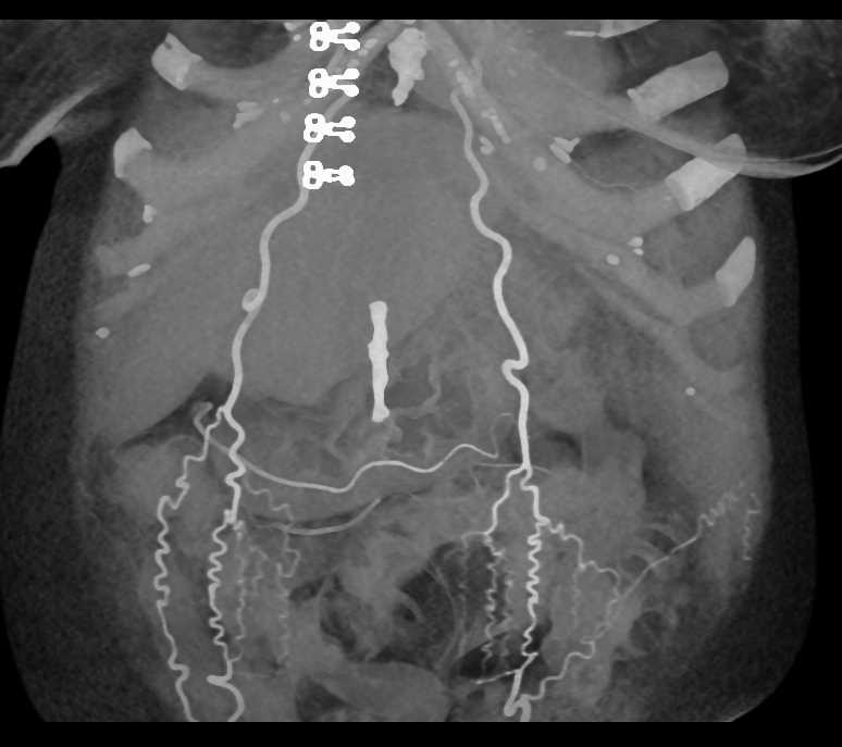 Collateral Vessels in the Abdominal Wall due to Liver Disease - CTisus CT Scan