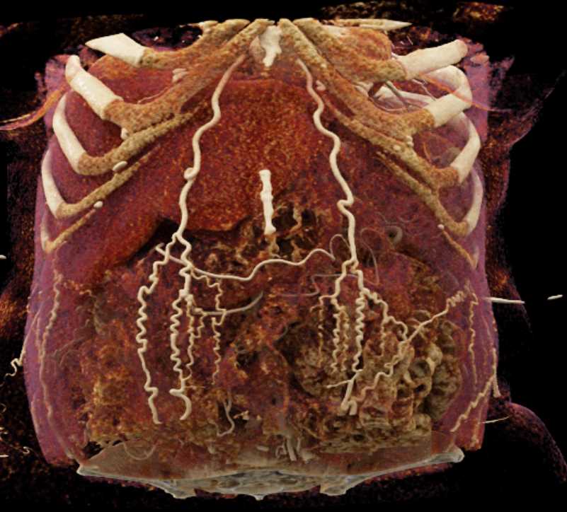 Collateral Vessels in the Abdominal Wall due to Liver Disease - CTisus CT Scan