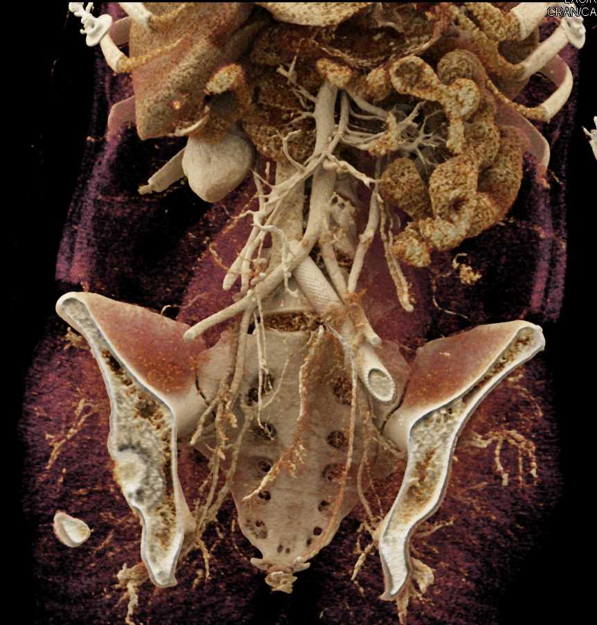 Cinematic Rendering of the Bladder and Ovarian Metastases and Stent in Left Iliac Vein - CTisus CT Scan