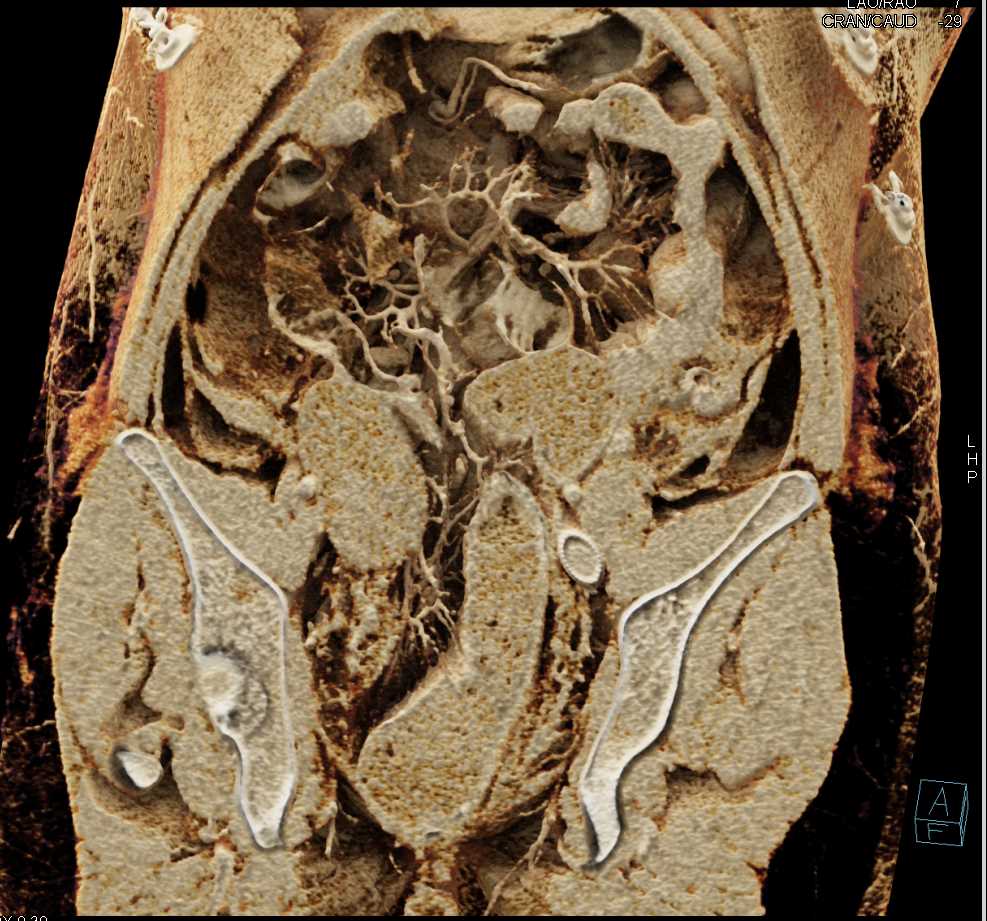 Cinematic Rendering of the Bladder and Ovarian Metastases and Stent in Left Iliac Vein - CTisus CT Scan