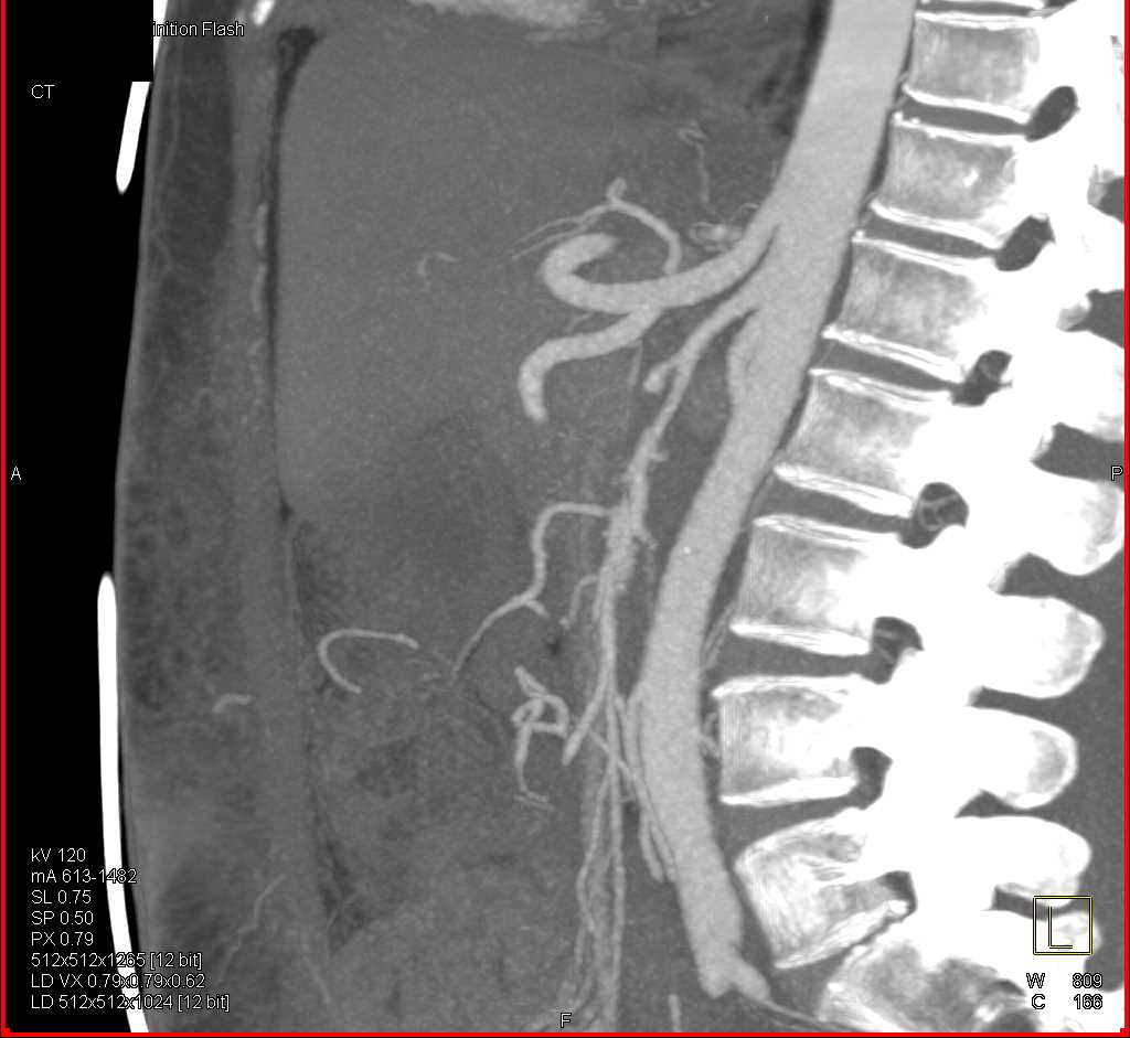 Mesenteric Vasculitis - CTisus CT Scan