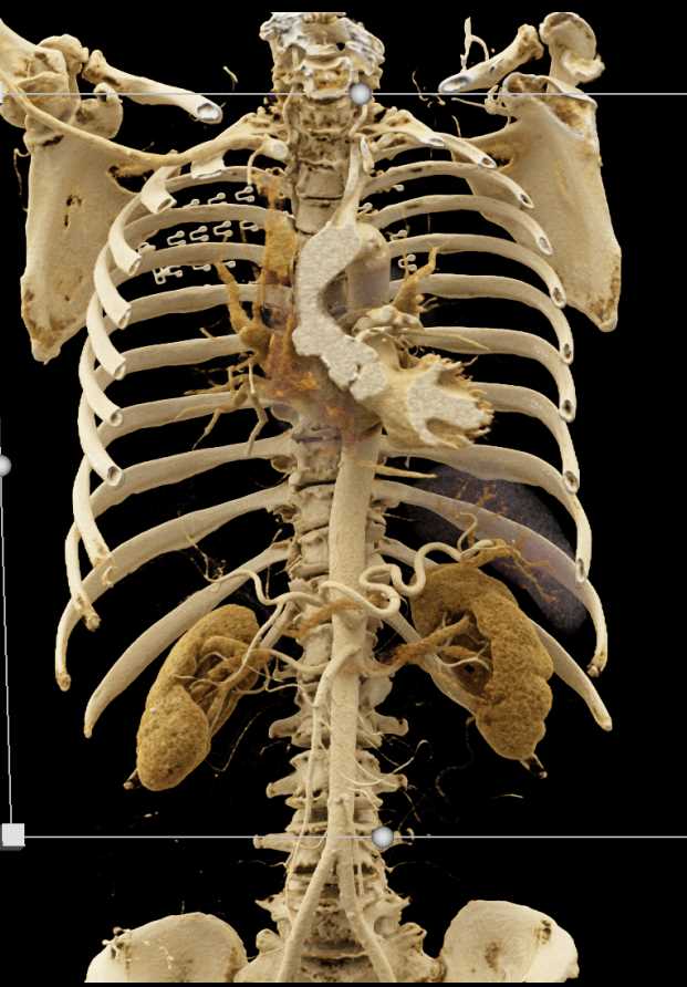 Pseudoaneurysm from Aortic Root - CTisus CT Scan