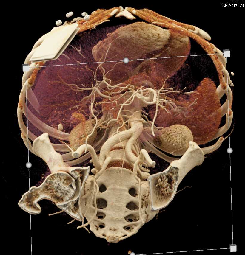 Vascular Mapping with Cinematic Rendering - CTisus CT Scan