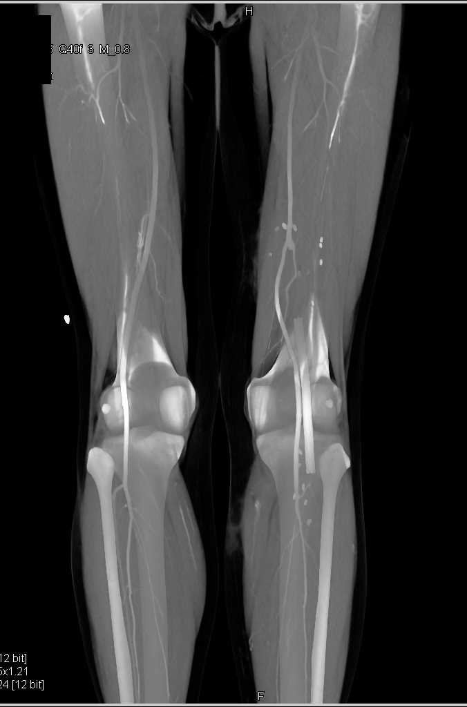 Vascular Mapping with Venous Contamination in the Lower Extremities - CTisus CT Scan