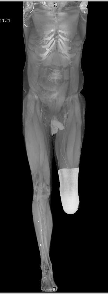 Below Knee Amputation and Severe Vascular Disease - CTisus CT Scan