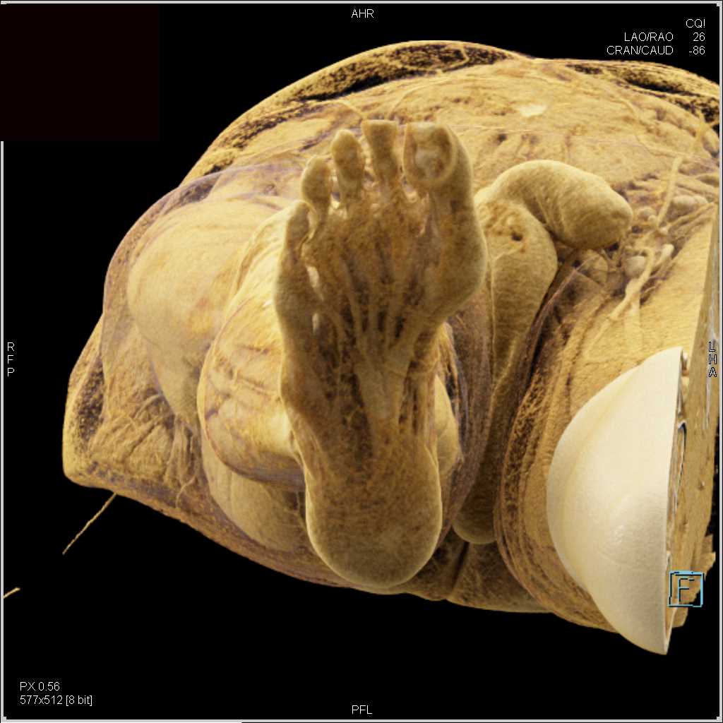 Below Knee Amputation and Severe Vascular Disease - CTisus CT Scan