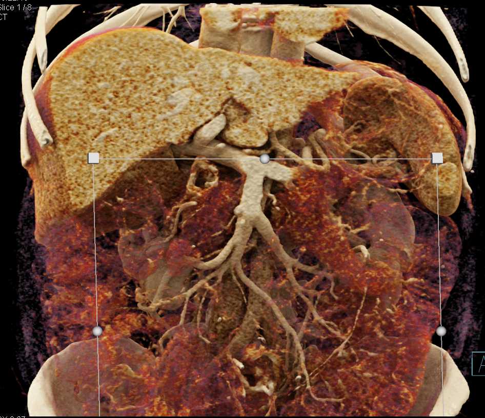 Normal Portal Vein and Left Renal Vein - CTisus CT Scan