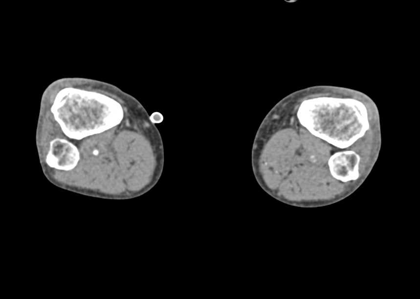 Vascular Disease at Level of Left Trifurcation Vessels - CTisus CT Scan