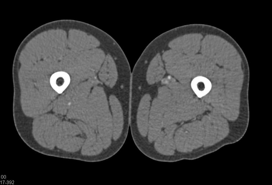 Peripheral Vascular Disease with Right Superficial Femoral Artery (SFA) Occlusion - CTisus CT Scan