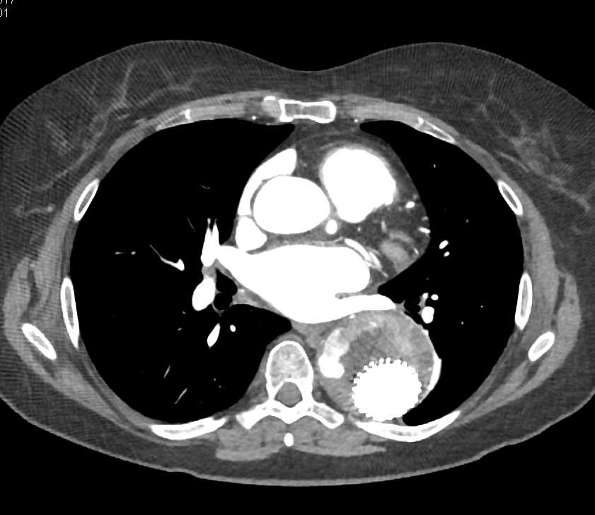 Endovascular Stent with Endoleak - CTisus CT Scan