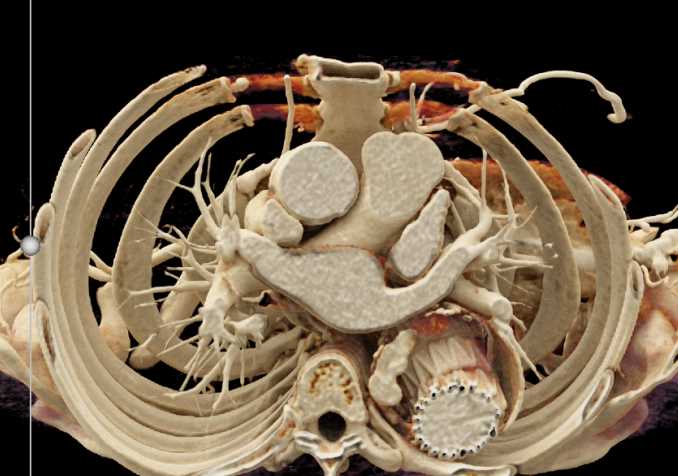 Endovascular Stent with Endoleak - CTisus CT Scan