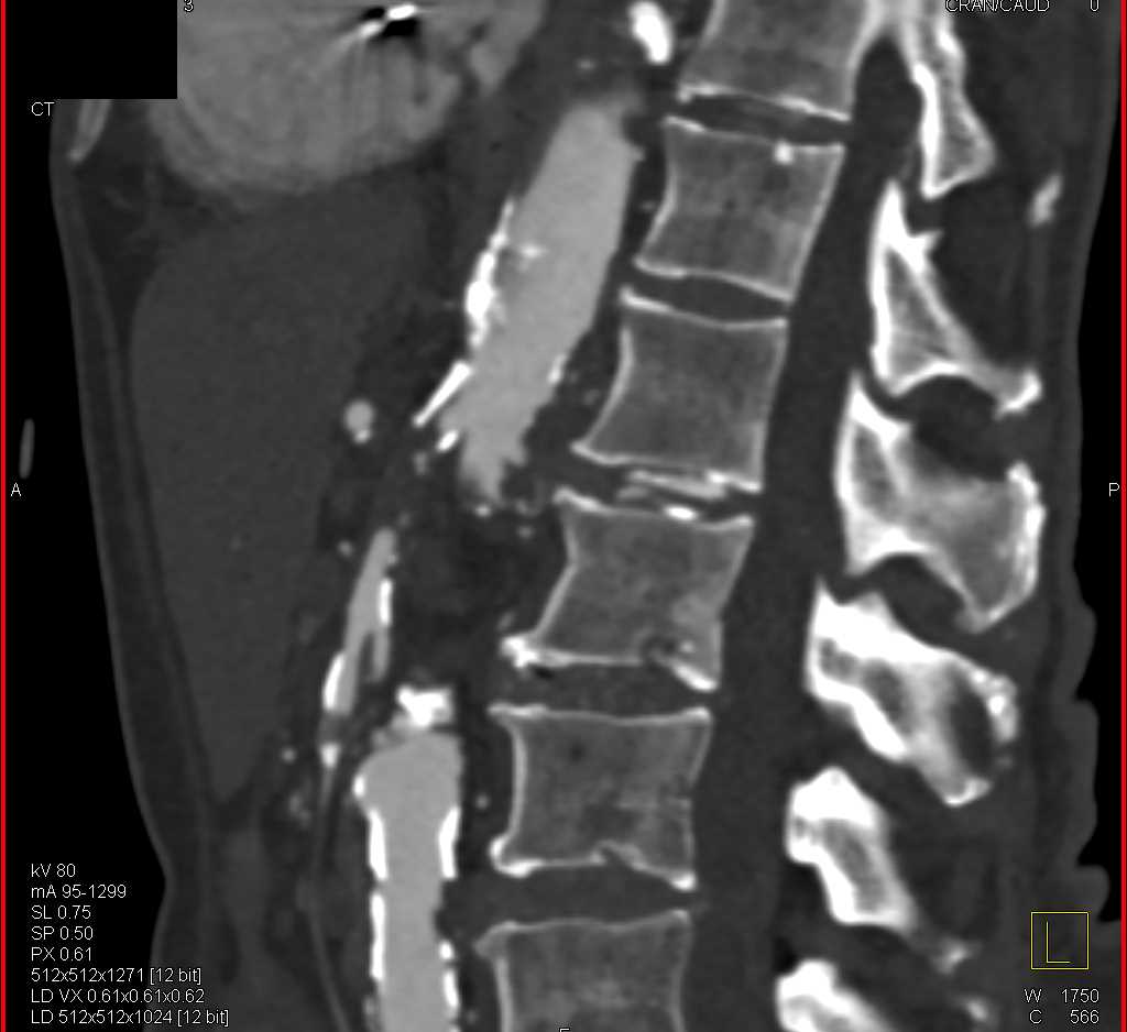 Aortic Occlusion - CTisus CT Scan