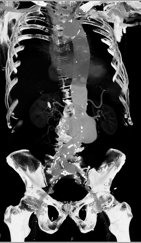 Abdominal Aortic Aneurysm - CTisus CT Scan