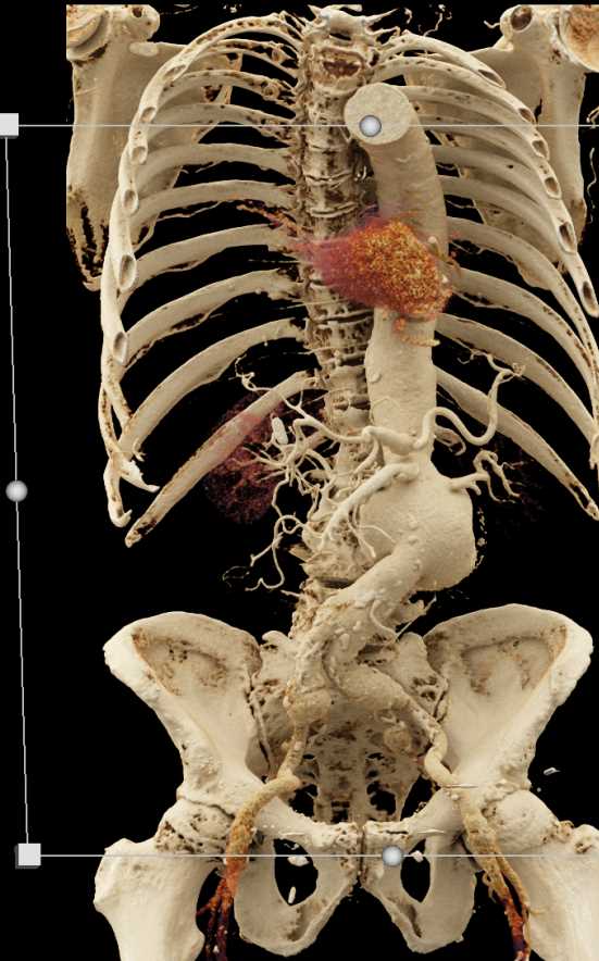 Abdominal Aortic Aneurysm - CTisus CT Scan