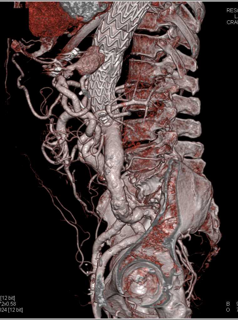 Endovascular Leak - CTisus CT Scan