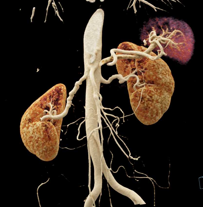 Fibromuscular Dysplasia Renal Arteries - CTisus CT Scan