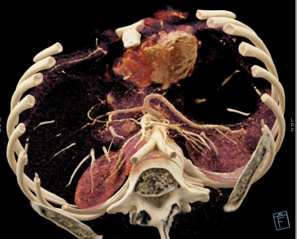 Celiac and Superior Mesenteric Artery (SMA) Branching - CTisus CT Scan