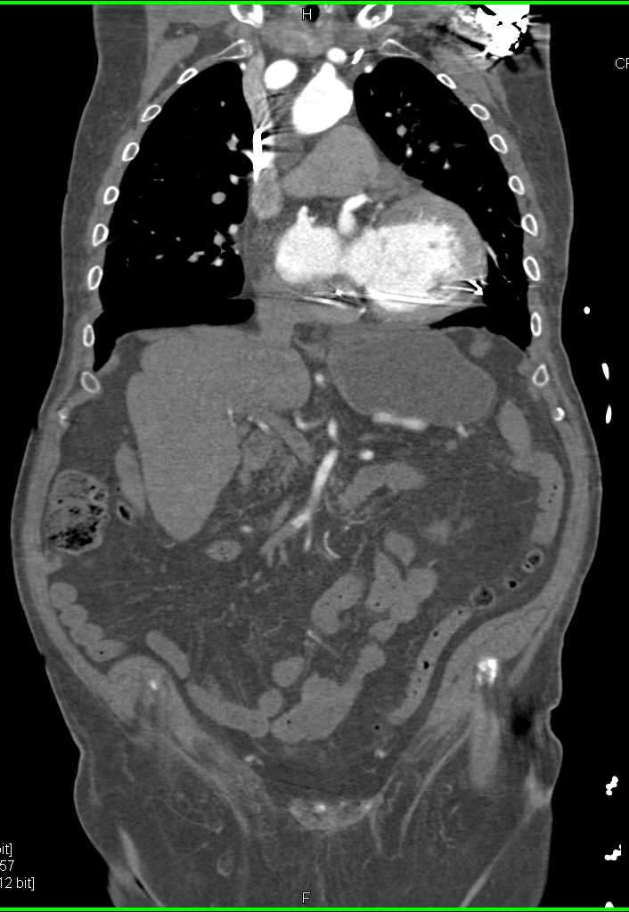 Clot in the Superior Mesenteric Artery (SMA) - CTisus CT Scan