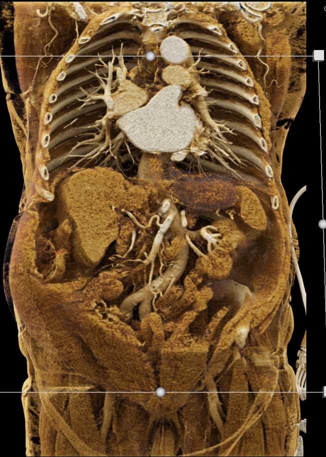 Multiple Clots in the Superior Mesenteric Artery (SMA) - CTisus CT Scan