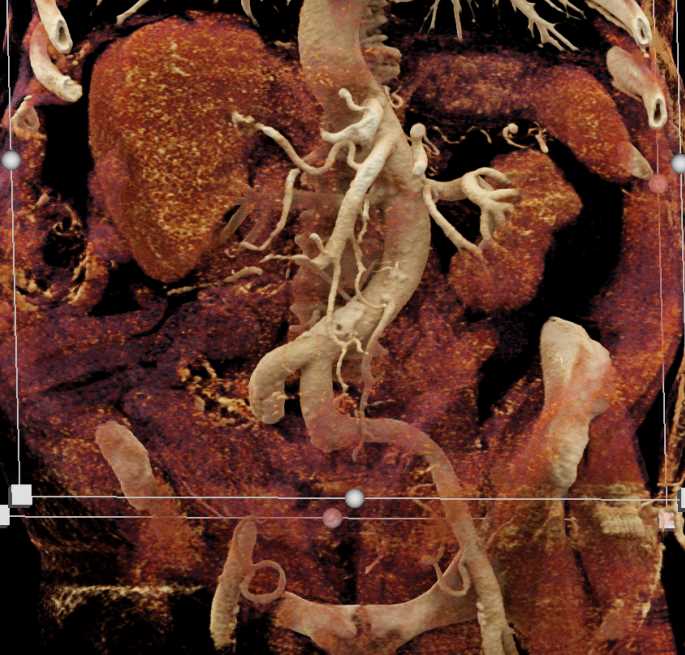 Multiple Clots in the Superior Mesenteric Artery (SMA) - CTisus CT Scan