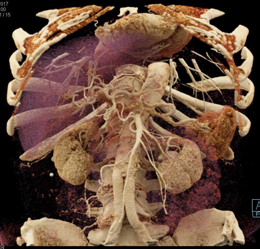 CTA of the Mesenteric Vessels with Cinematic Rendering - CTisus CT Scan