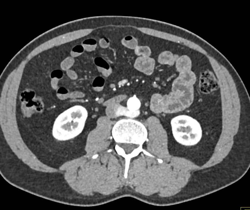 Hepatic Artery Aneurysm - CTisus CT Scan