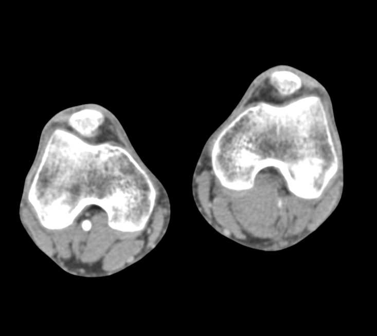 Popliteal Artery Occlusion - CTisus CT Scan