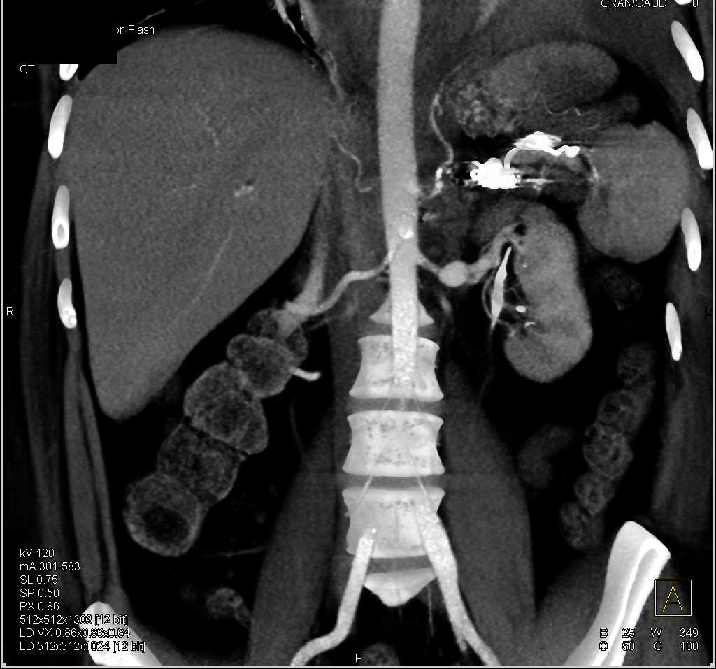 Left Renal Artery Aneurysm - CTisus CT Scan