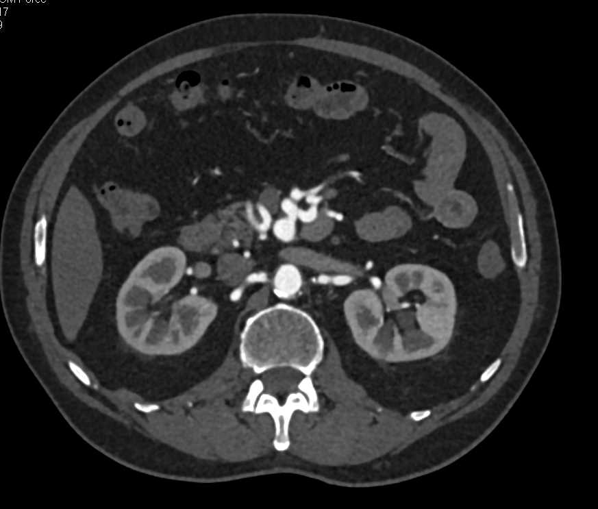 Multiple Mesenteric Artery Aneurysms - CTisus CT Scan