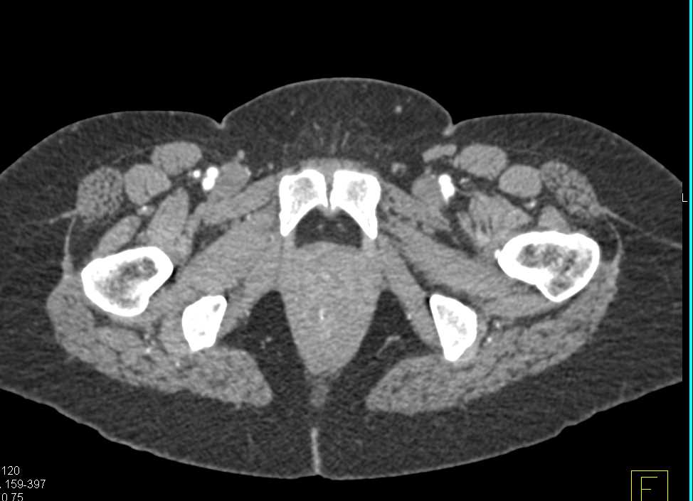 Femoral Artery Mapping - CTisus CT Scan