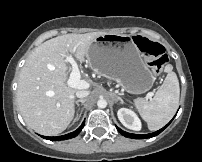 Celiac and Hepatic Artery Encasement - CTisus CT Scan