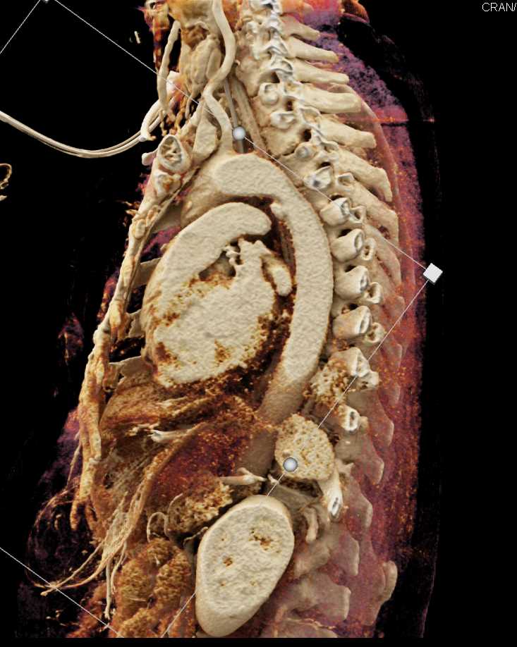 MVA with Chest and Aortic Trauma - CTisus CT Scan