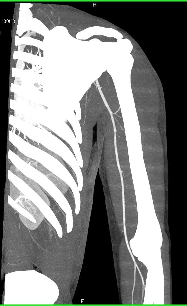 CTA of Axillary and Brachial Artery - CTisus CT Scan