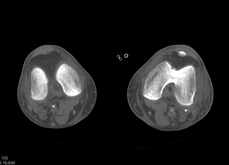 Multiple Sites of Vessel Occlusion - CTisus CT Scan