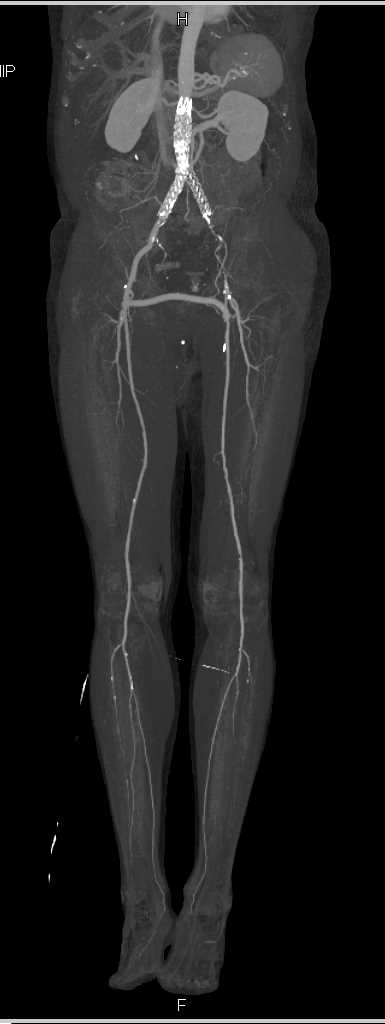 Fem-Fem Graft with Occluded Left Common Iliac Artery Stent and Peripheral Peripheral Arterial Disease (PAD) - CTisus CT Scan