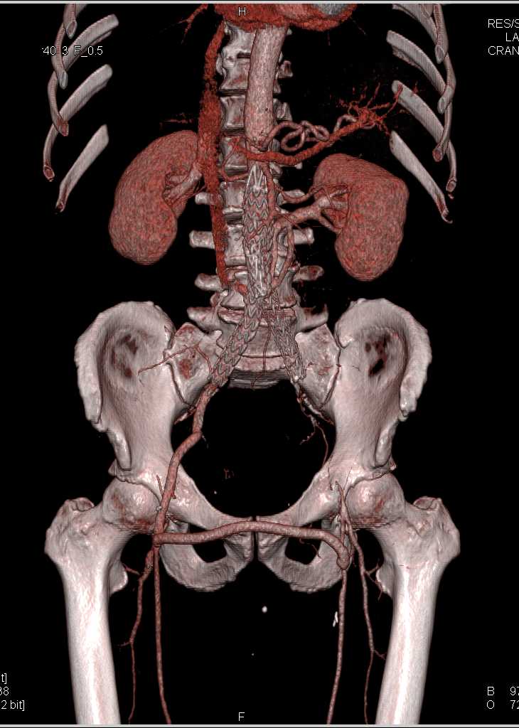 Fem-Fem Graft with Occluded Left Common Iliac Artery Stent and Peripheral Peripheral Arterial Disease (PAD) - CTisus CT Scan