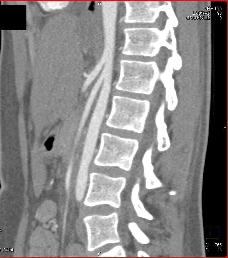 Superior Mesenteric Artery (SMA) Syndrome - CTisus CT Scan