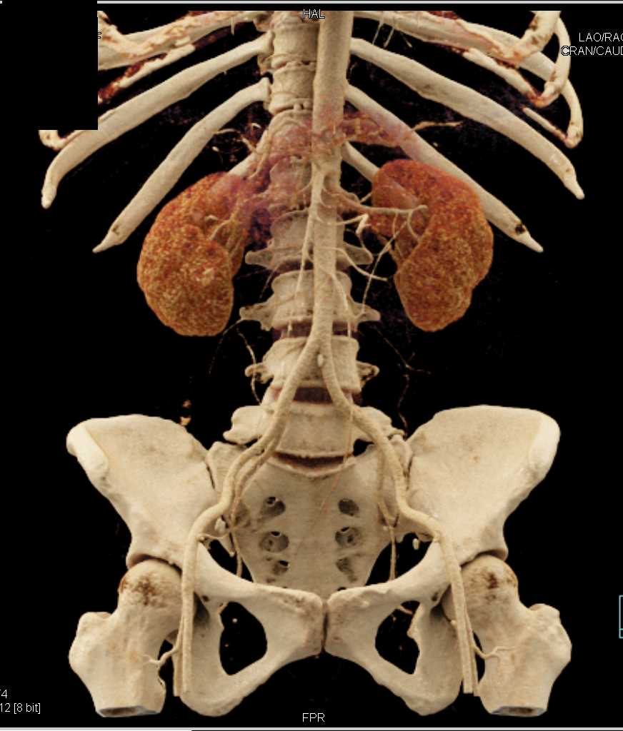 Cinematic Rendering of the Aorta and Iliac Vessels - CTisus CT Scan