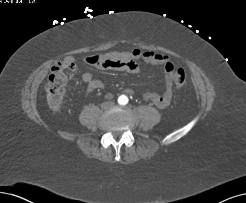 CTA Runoff with Left Superficial Femoral Artery (SFA) Occlusion and Right Popliteal Artery - CTisus CT Scan