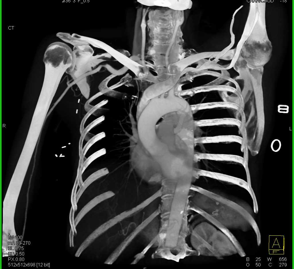 Stenosis in Right Subclavian Artery - CTisus CT Scan