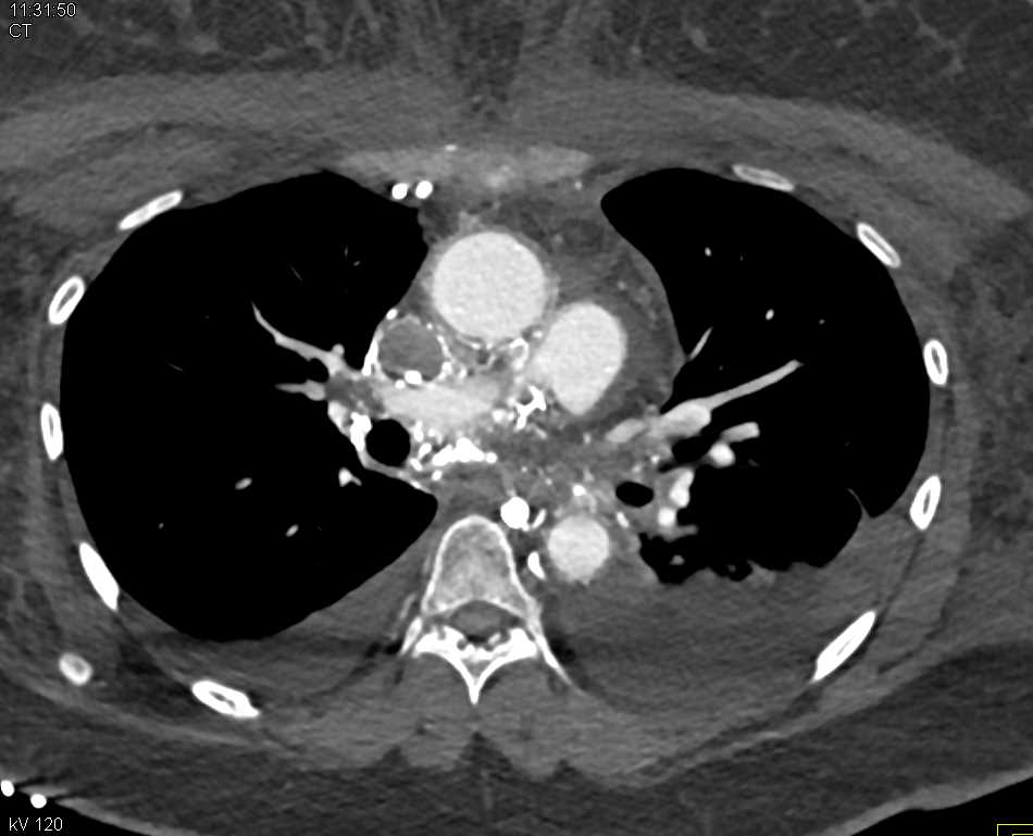 Superior Vena Cava (SVC) Occlusion Accentuated by Timing - CTisus CT Scan