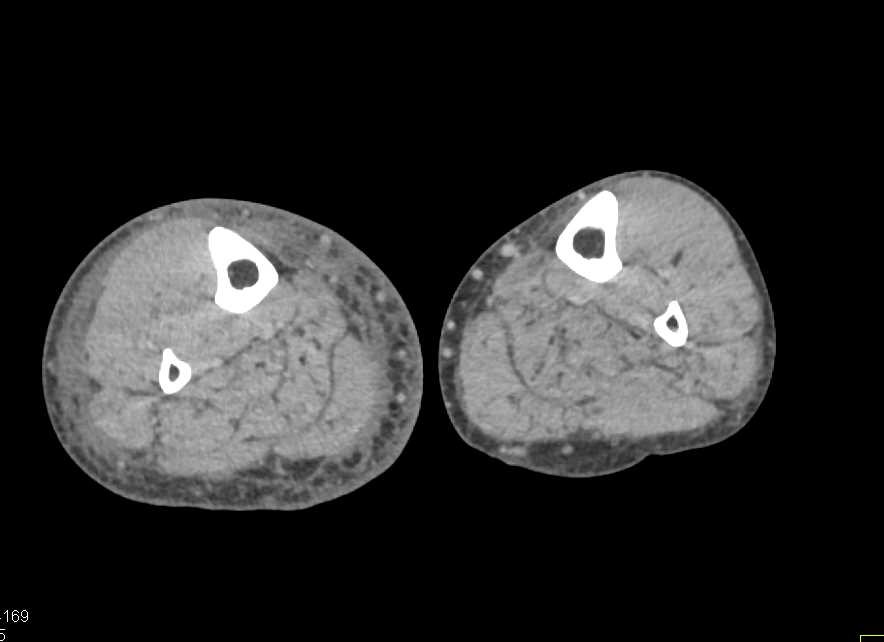 Occlusion Right Common Iliac Artery with Collaterals - CTisus CT Scan