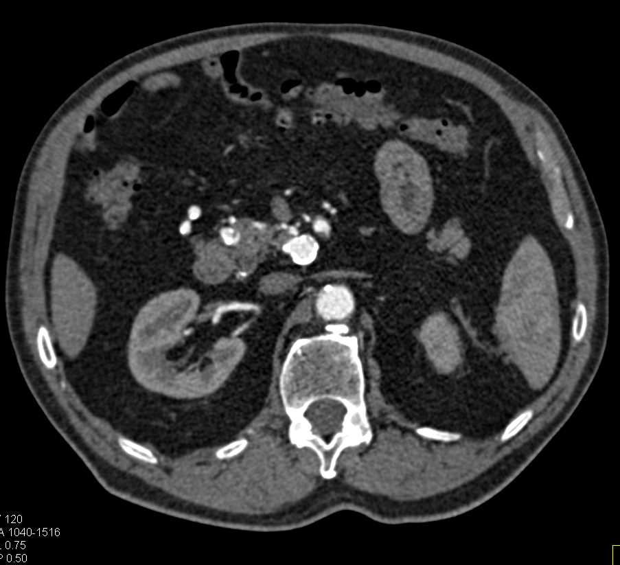 Multiple Aneurysms off the Gastroduodenal Artery (GDA) - CTisus CT Scan