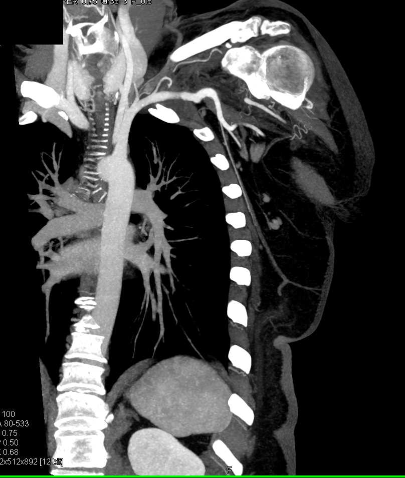Brachial Artery Occlusion Vascular Case Studies CTisus CT Scanning